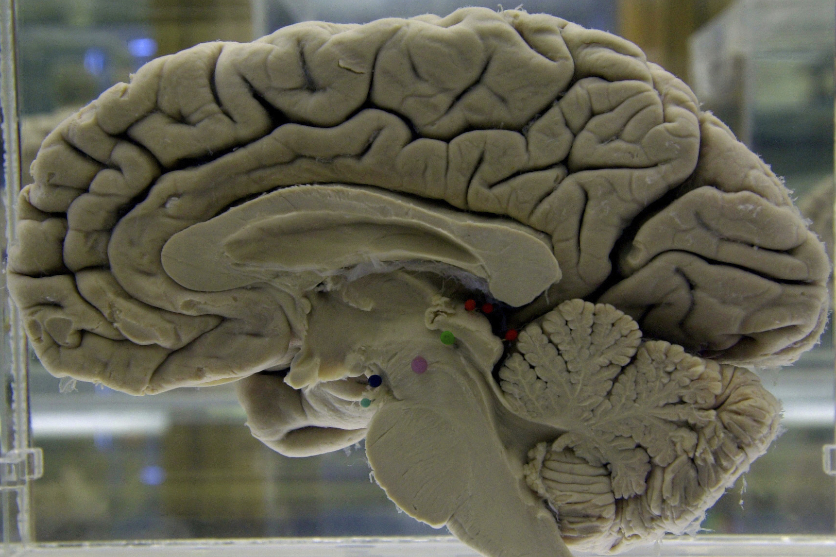 风暴平台官方：研究发现：乐观者有相似大脑活动模式